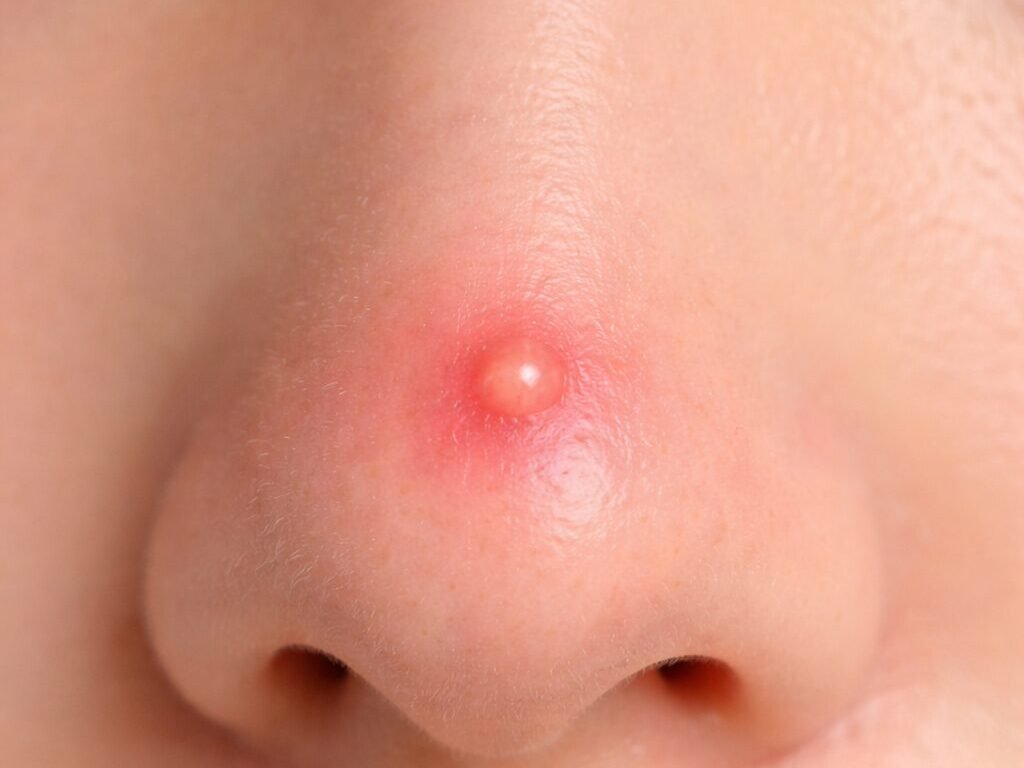 鼻子痘痘感染致命